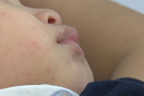 Trẻ mắc tay chân miệng trở nặng do sai lầm của phụ huynh