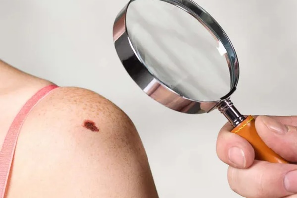 Khi ung thư da tìm đến bạn, cơ thể xuất hiện 7 dấu hiệu cảnh báo-1