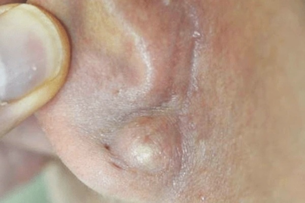 Hiểm hoạ từ dái tai sưng-1