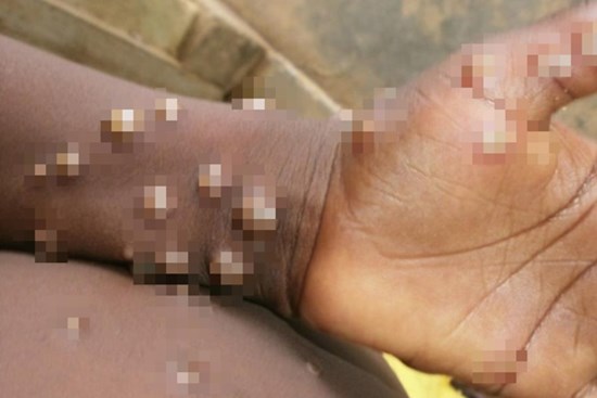 Lo ngại virus đậu mùa khỉ sẽ nối tiếp đại dịch COVID-19