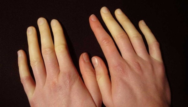 Những thay đổi lạ trên bàn tay tiết lộ chức năng thận hoạt động bất thường-4