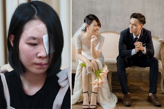 Cô gái bị tạt axit trong cơn ghen ở TP.HCM: 20 lần lên bàn mổ và niềm hạnh phúc vô giá