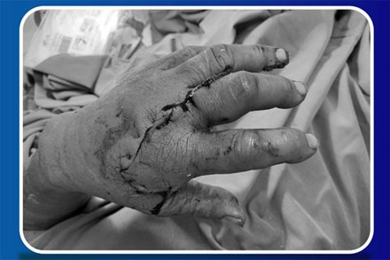 Người đàn ông đến bệnh viện với 2 ngón tay đứt lìa được ướp đá