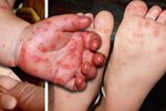 7 người chết vì sốt xuất huyết, nguy cơ bùng phát dịch-2