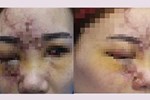 Cô gái 27 tuổi bị mù mắt phải sau khi tiêm filler nâng mũi-1