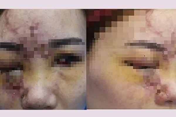 Tiêm filler đội lốt collagen, nhiều người gặp biến chứng-2