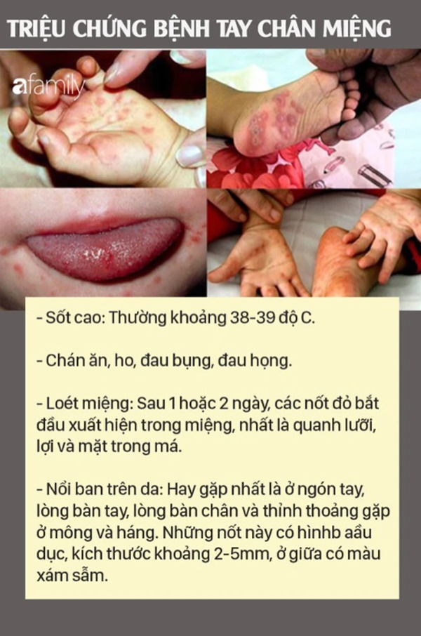 Bệnh tay chân miệng: Căn bệnh lây mạnh, dấu hiệu dễ bỏ qua, biến chứng cao-1