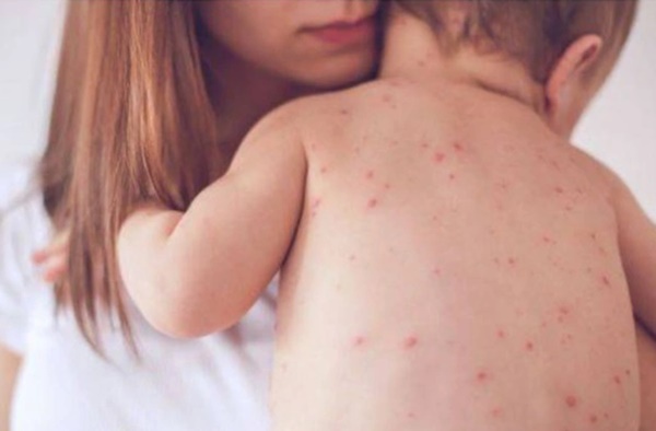 Bệnh tay chân miệng: Căn bệnh lây mạnh, dấu hiệu dễ bỏ qua, biến chứng cao-2