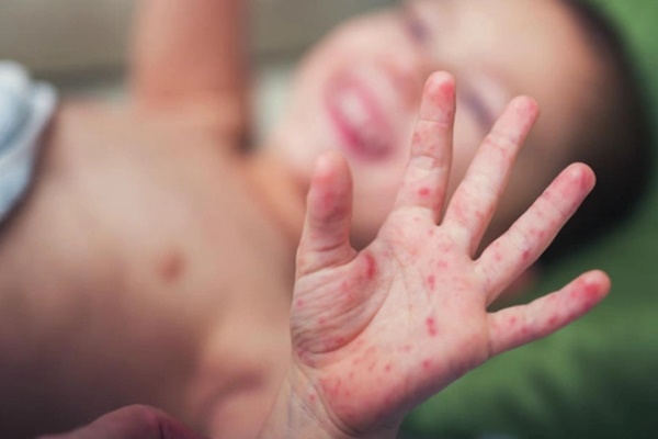 Bệnh tay chân miệng: Căn bệnh lây mạnh, dấu hiệu dễ bỏ qua, biến chứng cao-3