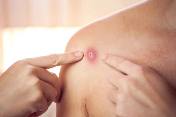 Bệnh đậu mùa khỉ: Bỉ ban hành lệnh cách ly, Mỹ hỏa tốc mua vắc-xin-3