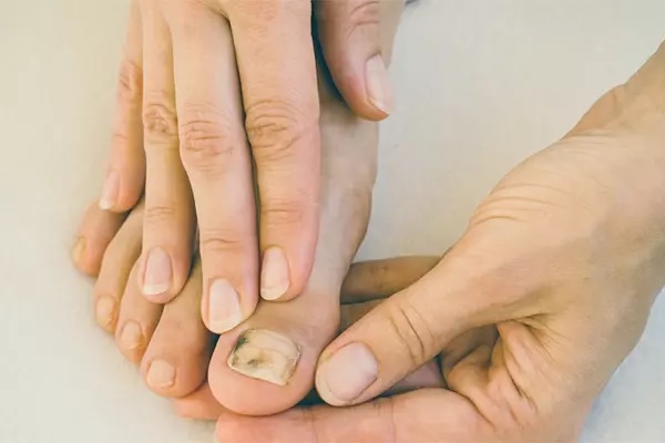 Người phụ nữ phát hiện bị ung thư nhờ điểm lạ ở ngón chân-1