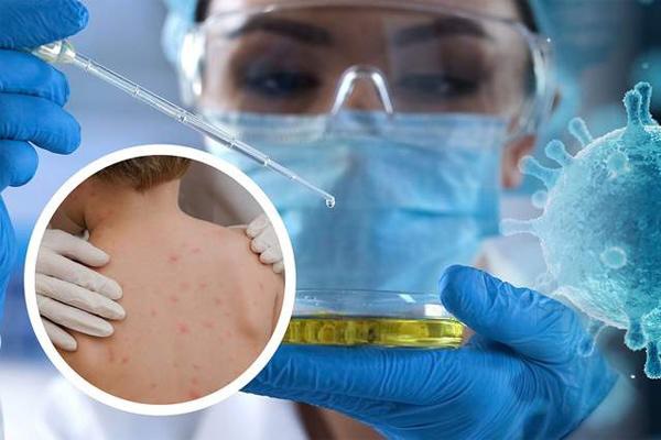 Bệnh đậu mùa khỉ: Đường lây truyền và cách phòng ngừa cần làm ngay-1