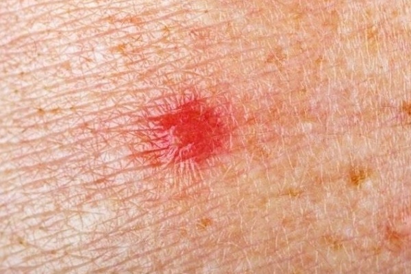 Không chỉ u cục, đây là 9 triệu chứng điển hình của ung thư vú cần can thiệp sớm-2