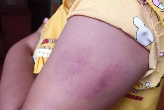 Học sinh lớp 1 bị cô giáo đánh tím tay vì đọc viết chưa thạo