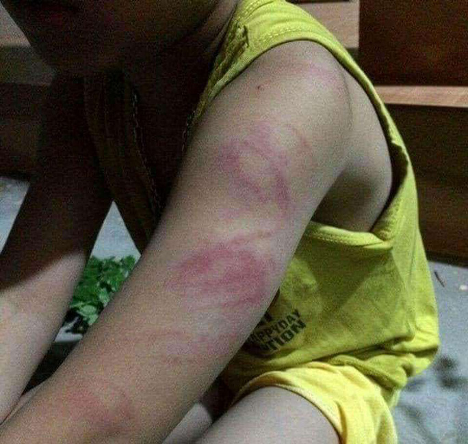 Học sinh lớp 1 bị cô giáo đánh tím tay vì đọc viết chưa thạo-1