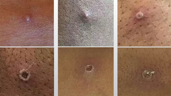 Khác biệt giữa phát ban do Covid-19 và đậu mùa khỉ-1