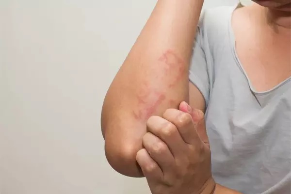 Khác biệt giữa phát ban do Covid-19 và đậu mùa khỉ-2