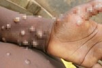 Bộ Y tế hướng dẫn người dân cách phòng tránh bệnh đậu mùa khỉ-2