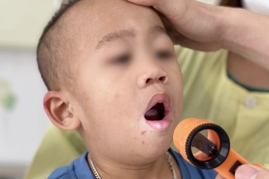 Dấu hiệu trẻ mắc tay chân miệng cần nhập viện