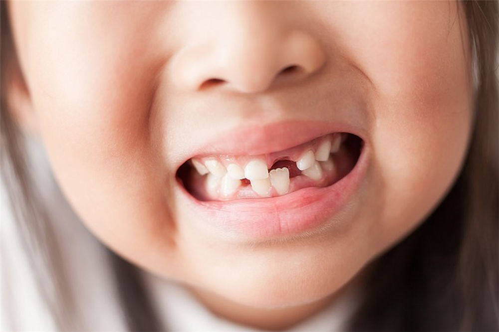 Đứa trẻ 3 tuổi được yêu cầu đeo niềng răng 24 giờ/ngày, cần thiết hay không?-2