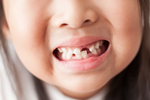Đứa trẻ 3 tuổi được yêu cầu đeo niềng răng 24 giờ/ngày, cần thiết hay không?
