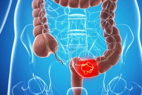 Cách đơn giản nhận biết dấu hiệu ung thư đại trực tràng-1