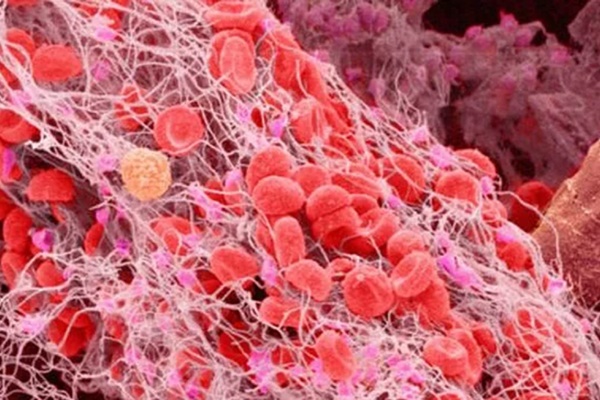 2 thói quen xấu vào mùa hè mà nhiều người mắc phải có thể hình thành cục máu đông, làm tăng nguy cơ mắc các bệnh tim mạch, thậm chí gây đột tử-6