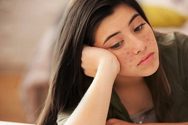 Phụ nữ có gan yếu thường xuất hiện 6 dấu hiệu, chú ý thải độc cơ thể gấp-4