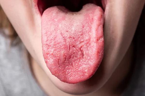 3 dấu hiệu ở lưỡi cảnh báo bệnh tim mạch đang âm thầm tìm đến bạn-3