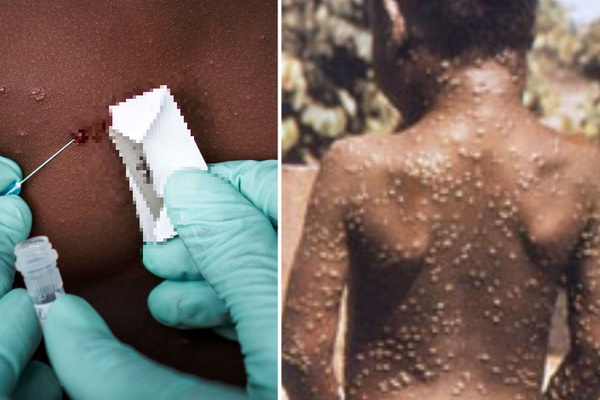 Bệnh đậu mùa khỉ đã lan ra 30 quốc gia-1