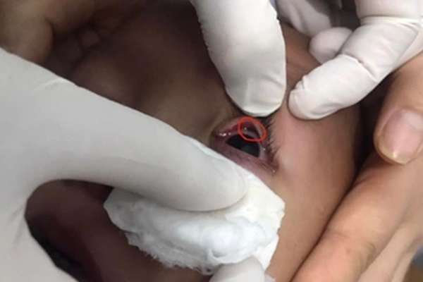 Kinh hãi vắt rừng căng máu ký sinh trong đường thở bé 6 tuổi-3