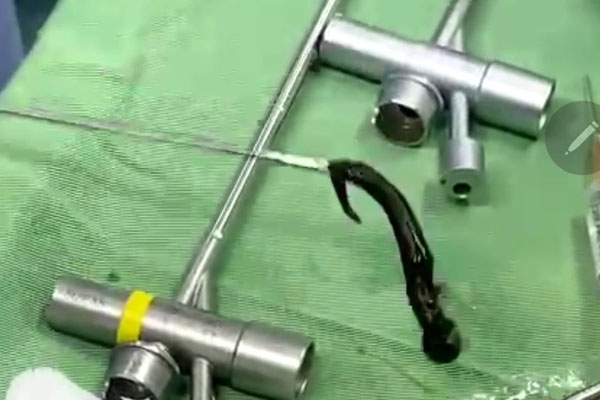 Kinh hãi vắt rừng căng máu ký sinh trong đường thở bé 6 tuổi-2