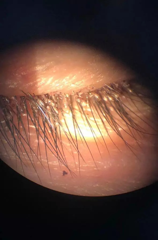 Gần 100 con rận mu làm tổ trên mi mắt người đàn ông-1