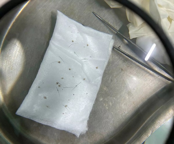 Gần 100 con rận mu làm tổ trên mi mắt người đàn ông-2