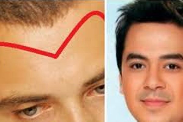 Nhìn trán biết số mệnh: 5 tướng trán sướng từ trong trứng, ngồi mát ăn bát vàng, 2 kiểu làm mấy vẫn nghèo hèn-1