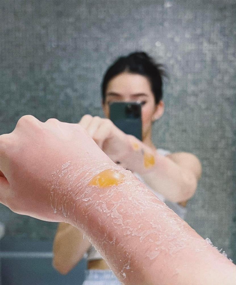 Hãi hùng Lưu Đê Ly bị nước sôi đổ vào người, cánh tay nát tươm-2
