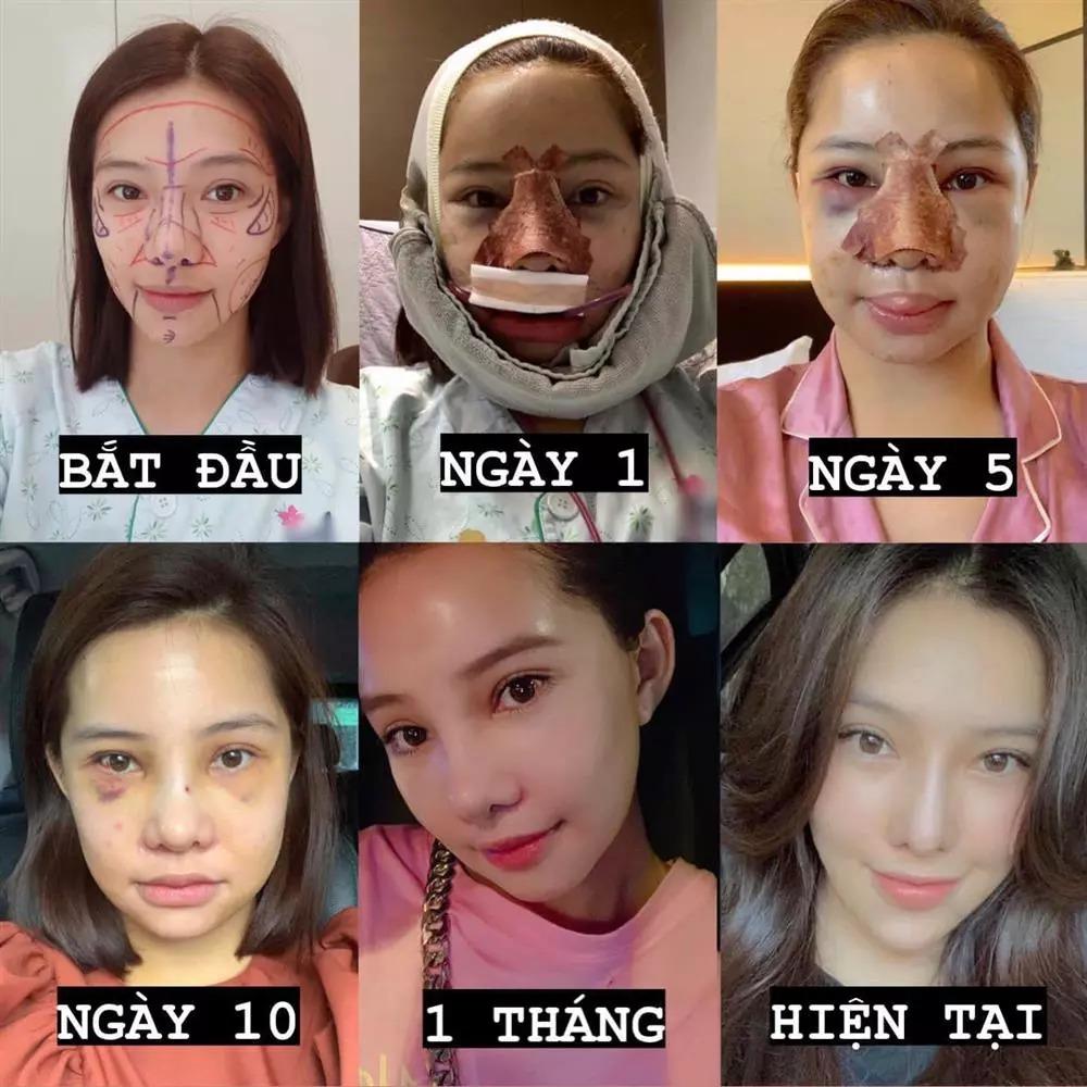 Hãi hùng Lưu Đê Ly bị nước sôi đổ vào người, cánh tay nát tươm-10