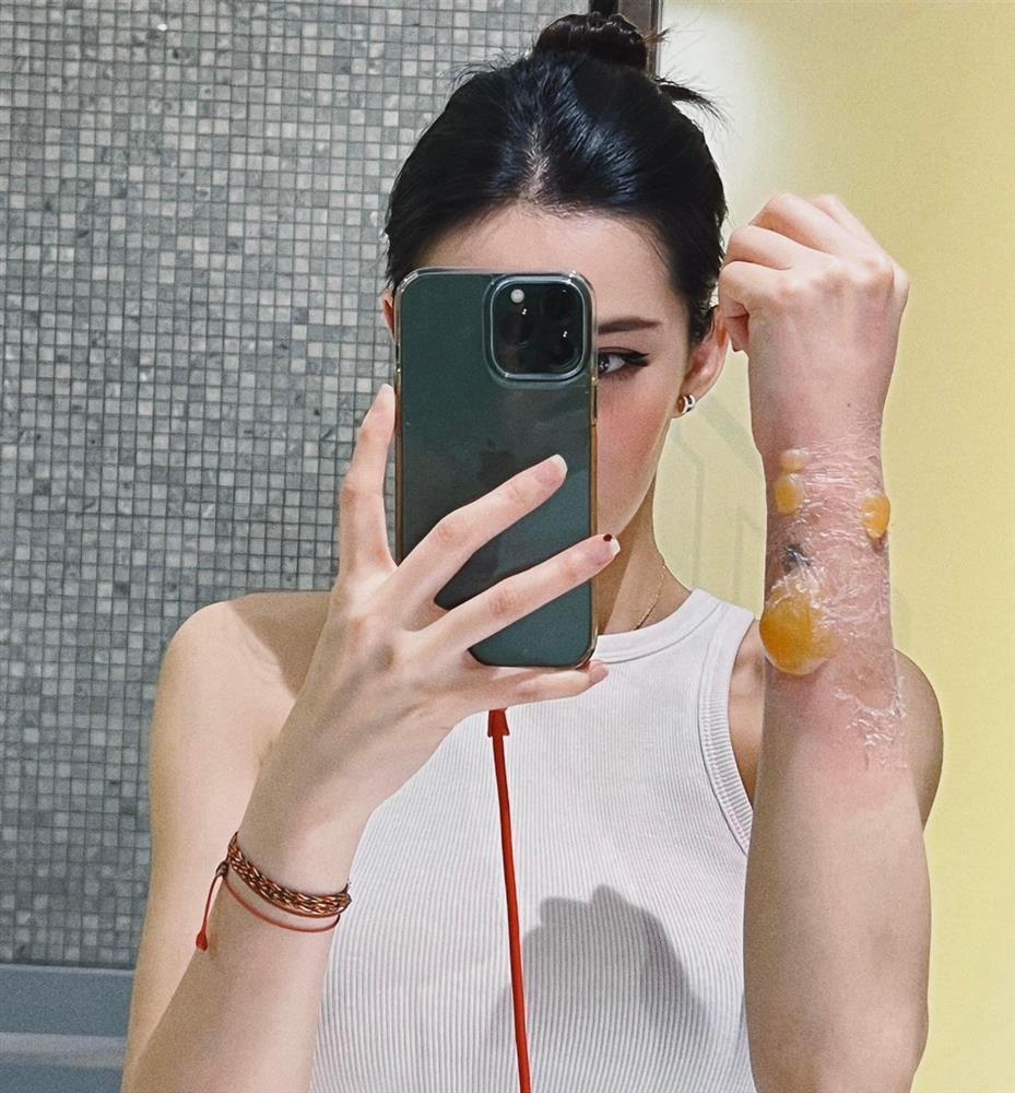 Hãi hùng Lưu Đê Ly bị nước sôi đổ vào người, cánh tay nát tươm-3