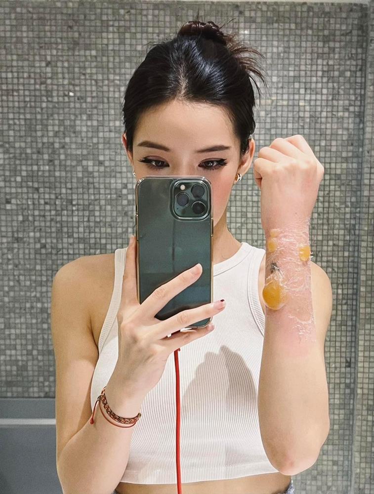 Hãi hùng Lưu Đê Ly bị nước sôi đổ vào người, cánh tay nát tươm-4