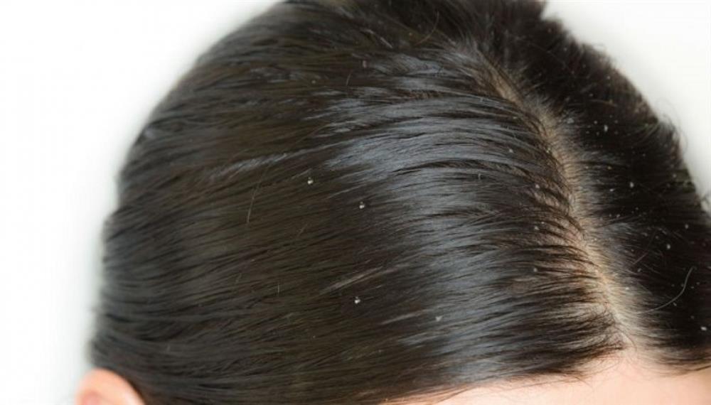 Tóc nhanh bết do đâu và làm sao để khắc phục tình trạng đầu vừa gội đã bết-2