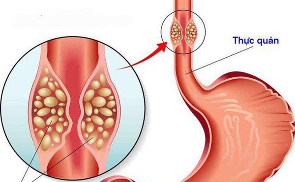 3 thói quen ăn uống dễ dẫn đến ung thư thực quản, giới trẻ nên từ bỏ sớm!-1