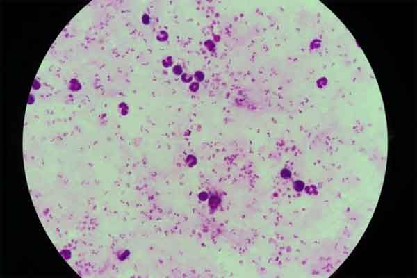 Hai người Việt từ châu Phi về bị sốt rét ác tính-1