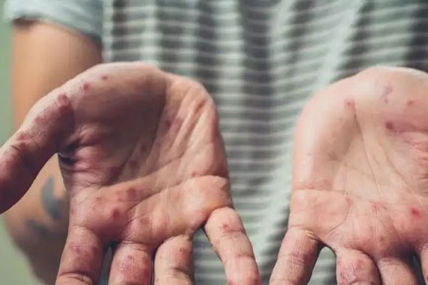 Chủng virus đậu mùa khỉ có 47 đột biến mới-3