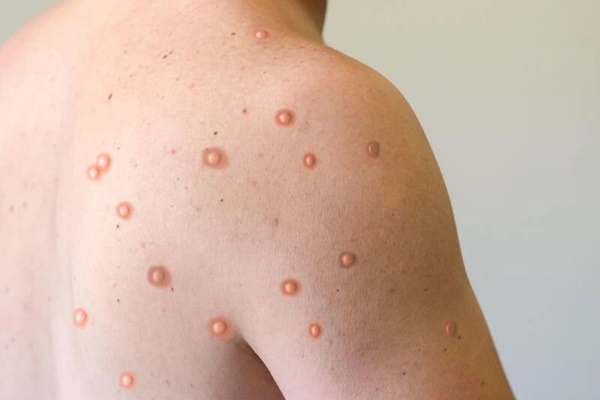 Đậu mùa khỉ có thể lây lan qua không khí-2