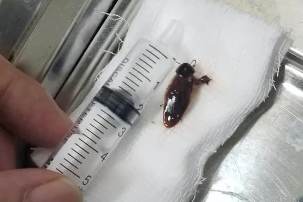 Đột ngột đau tai khi ngủ, vào viện bác sĩ gắp con gián còn sống trong tai-1