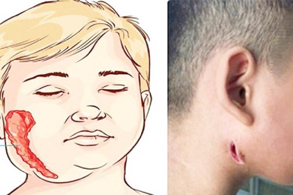 Diễn biến sức khỏe bé gái bị nhiễm vi khuẩn ăn thịt người-2