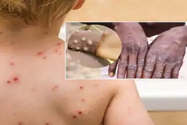 Những người được giám sát đậu mùa khỉ tại TP.HCM-2