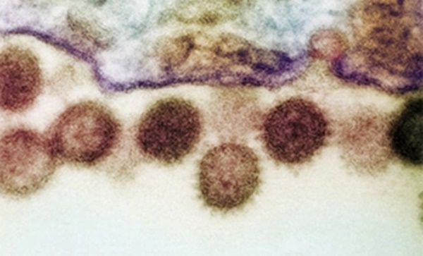 Loại virus có thể gây tử vong tới 40% chỉ sau cơn sốt-2