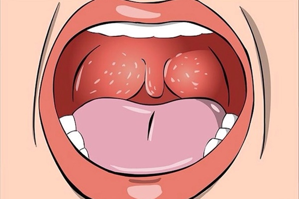 3 triệu chứng xuất hiện ở cổ họng ngầm cảnh báo phổi đang bị tổn thương, ngay từ điều đầu tiên đã rất đáng lo-1