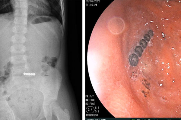 Ve chó làm tổ trong tai bé 5 tuổi, bác sĩ cảnh báo thói quen ăn, ngủ cùng thú cưng của nhiều người-2
